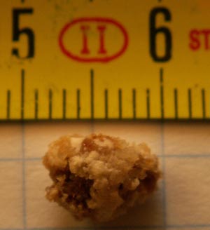 kidneystone_9mm_crystal1.jpg